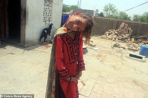 «کج گردنی»، اختلال عجیب دختر پاکستانی