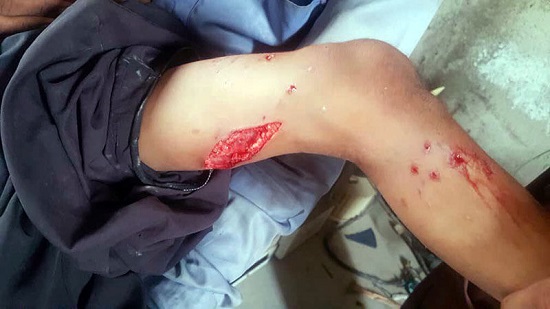 آسیب سطحی در حمله تمساح به یک کودک